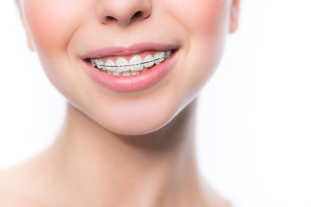 Woman with teeth braces Beautiful young woman with teeth braces isolated on white orthodontist stock pictures, royalty-free photos & images