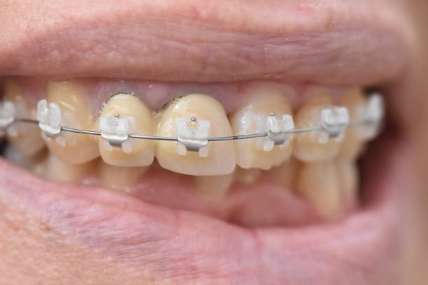 Ceramic braces are popular with adults. This is because they are made of translucent material, which is less noticeable. Some come with tooth-colored wires, which make them even more appealing. Pros: They are less visible than metal braces and move teeth faster than clear plastic aligners (Invisalign). They move teeth faster than clear aligners (Invisalign). Ceramic braces take about 18 to 36 months to straighten your teeth. Popular clear-alignment methods, such as Invisalign, can take a year or longer to work, even if your teeth don’t require much correction. Also, clear-alignment methods don’t work for severe cases of misalignment or malocclusion (a crooked bite). You can choose your colors. Metal braces only come in one color: gray (or shiny metallic silver, if it’s available). Ceramic braces are available in nearly any color imaginable. They don’t interfere with imaging tests. Metal braces can disrupt signals in imaging tests. Ceramic braces produce much less signal interference Cons: They are also more expensive than metal braces. They’re more expensive than metal braces. Ceramic braces can cost at least $1,000 to $2,000 more than metal braces. They may cause gum sensitivity. Ceramic brackets are larger than metal brackets. This can make it harder to clean around your brackets, leading to swollen gums or receding gums if your toothbrush doesn’t reach the enamel and gumline. They’re slightly less durable than metal. Ceramic braces are more than twice as likely to break off or fracture. The process of removing the glue (debonding) has also been known to cause damage to your tooth surface (enamel). They move teeth slower than metal. Because they’re more fragile, having to repair broken brackets or make incremental adjustments at each appointment can delay the straightening process. They may stain. The elastic ties holding the wire to the brackets can stain easily and remain stained until they’re replaced.