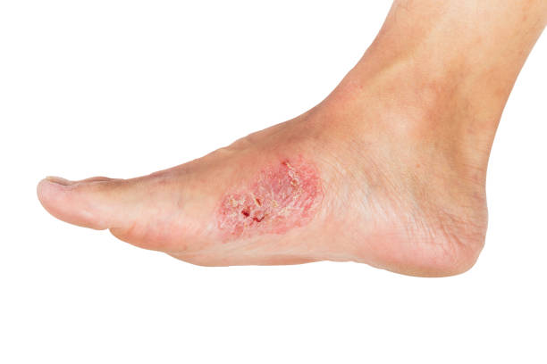 Wounds and dry skin on human foot. Wounds and dry skin on human foot. Ulcers and infection of medical concepts. foot exam diabetes stock pictures, royalty-free photos & images
