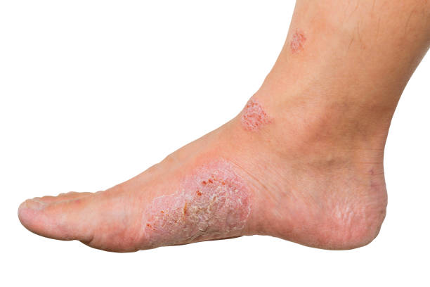 Wounds and dry skin on human foot. Ulcers and infection of medical concepts. Isolated human foot and white background. Ulcers and infection of medical concepts. foot exam diabetes stock pictures, royalty-free photos & images