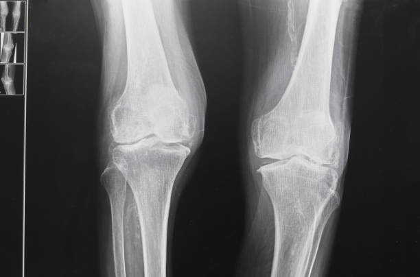 x ray image of knee. stock photo