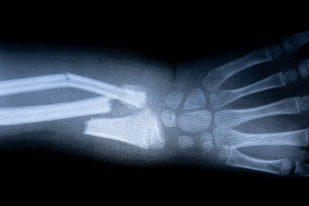 x-ray film skeleton human arm. health medical anatomy body concept stock photo