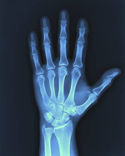 x-ray hand. - röntgenbild stock-fotos und bilder