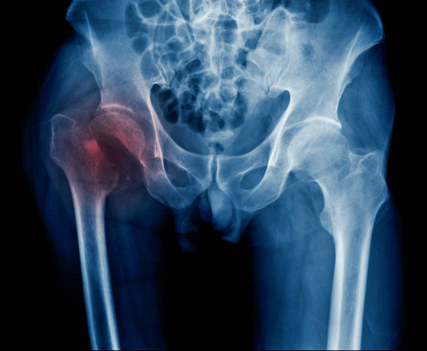 röntgen-hüfte fraktur des alten mann, x-ray bild intertrochanteric fraktur - hüfte stock-fotos und bilder