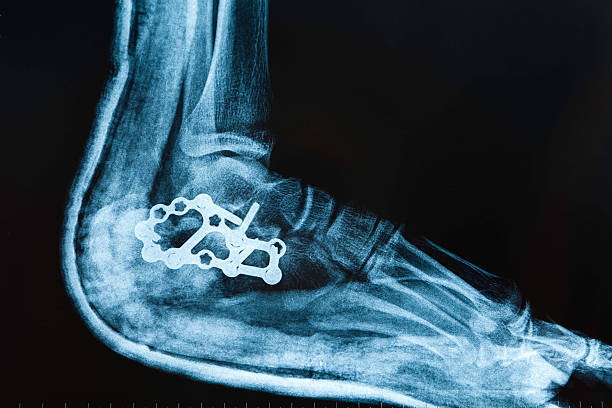 X-ray image ankle fracture X-ray image ankle fracture,  x ray plates stock pictures, royalty-free photos & images