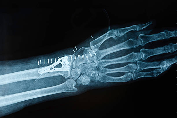 X-ray image hand fracture stock photo