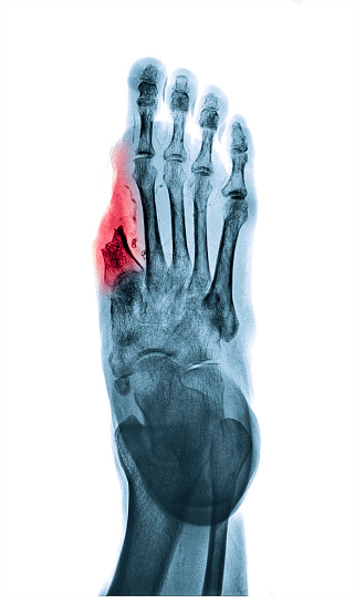 糖尿病患者の足切断の親指の X 線像白トーンにプロセスを逆に 四肢切断のストックフォトや画像を多数ご用意 Istock