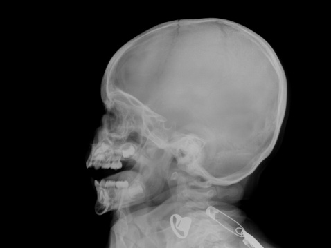 Xray Image Of Baby S Skull - X-ray for a child - Is X-ray Safe?
