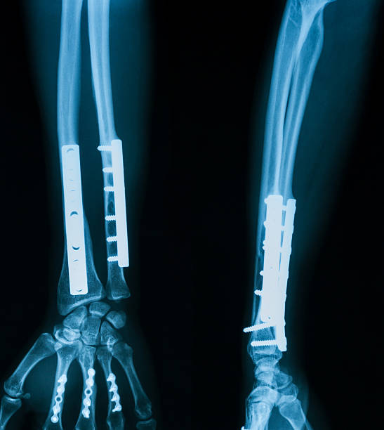 X-ray image of broken forearm,lateral view. X-ray image of ulnar and radius fracture, after operated and internal fixed by plate and screw x ray plates stock pictures, royalty-free photos & images