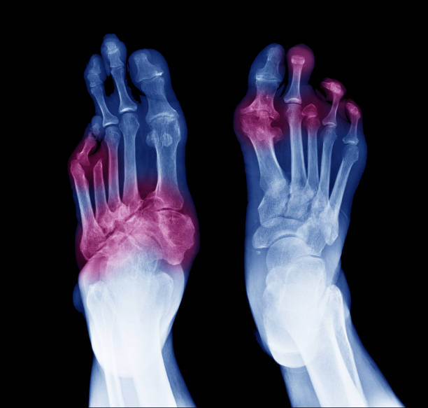 X-ray image of diabetic feet, posterior view show amputation toes and joint inflamed X-ray image of diabetic feet, posterior view show amputation toes and joint inflamed foot exam diabetes stock pictures, royalty-free photos & images