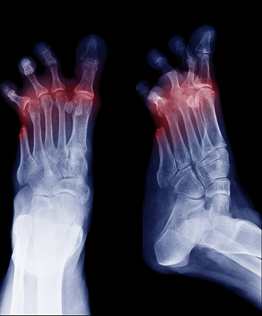 糖尿病性足切断ap斜視変形した足の指による撮影の X 線像 苦痛のストックフォトや画像を多数ご用意 Istock