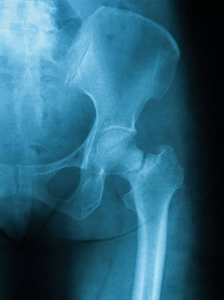 X-ray image of hip joint AP view, X-ray image of femoral neck fracture, AP view, showing femoral neck fracture. x ray plates stock pictures, royalty-free photos & images