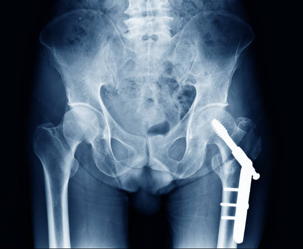 X-ray image of human left side hip fracture neck of femur bone. Open Reduction Internal Fixation with internal bone rod, plate and screw by Orthopedic surgeon X-ray image of human left side hip fracture neck of femur bone. Open Reduction Internal Fixation with internal bone rod, plate and screw by Orthopedic surgeon x ray plates stock pictures, royalty-free photos & images