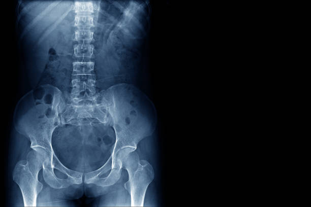 röntgenbild des normalen menschlichen wirbelsäule, rips, becken, beide gemeinsame und leere hüftbereich rechts - röntgenbild stock-fotos und bilder