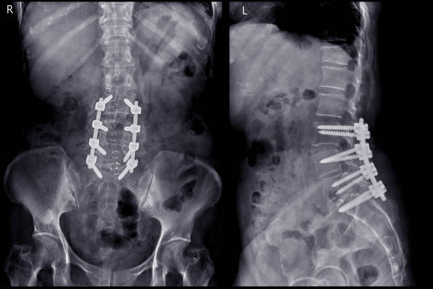 X-ray image of lambosacral spine or L-S spine AP and lateral Post operative  Lumbar Plates and screw. X-ray image of lambosacral spine or L-S spine AP and lateral Post operative  Lumbar Plates and screw. x ray plates stock pictures, royalty-free photos & images