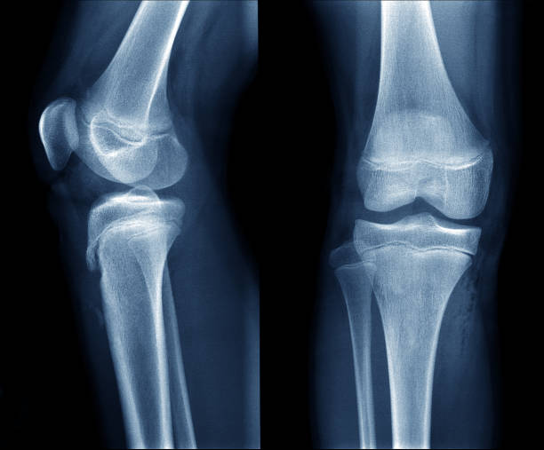 x-ray image of normal child / teenage knee show epiphyseal plate x-ray image of normal child / teenage knee show epiphyseal plate x ray plates stock pictures, royalty-free photos & images