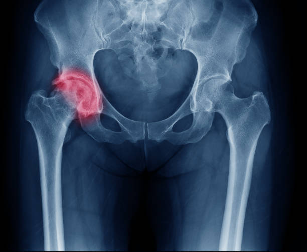 röntgenbild der schmerzhafte hüfte in frau vorliegenden arthrose rechten hüftgelenk im roten bereich mark - hüfte stock-fotos und bilder