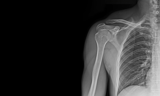 X-ray image of shoulder joint for to see injuries of tendons and bones.