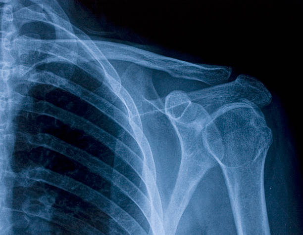 x-ray image der schulter - schulter stock-fotos und bilder