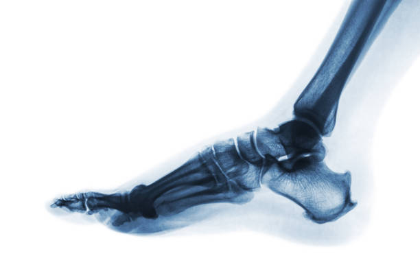 X-ray normal human foot . Lateral view . Invert color style X-ray normal human foot . Lateral view . Invert color style . lateral surface photos stock pictures, royalty-free photos & images