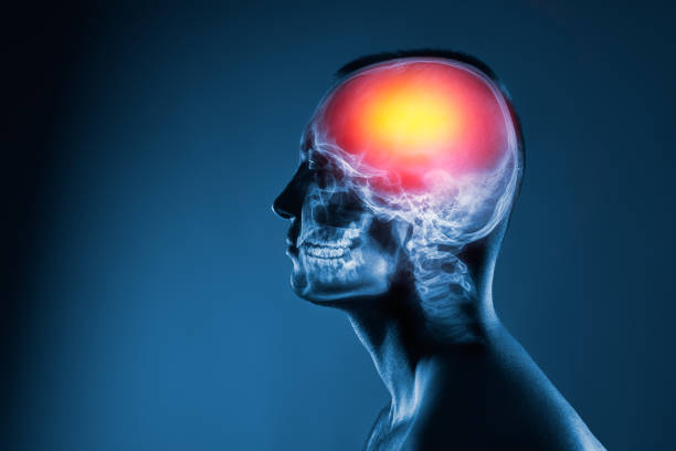 X-ray of a man's head. Cerebral stroke. Brain damage is highlighted by red colour. stock photo