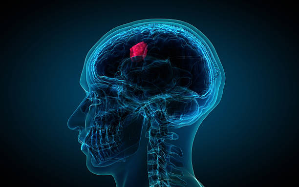 x-ray of brain showing tumor stock photo