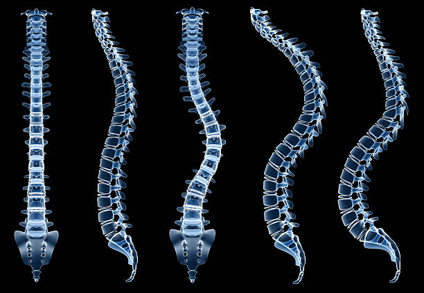 X-ray of human bones showing spine problems "X-ray of human bones showing spine problems like humpback, scolioses and  lordosis. On black background, great to be used in medicine works and health." cauda equina photos stock pictures, royalty-free photos & images