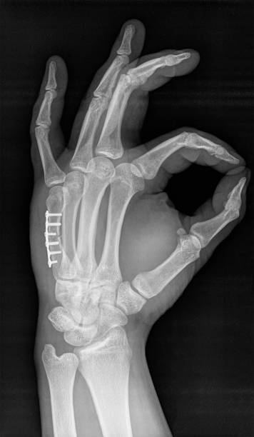 X-ray of human hand. V metacarpal bone with implant. X-ray of human hand. V metacarpal bone implanted surgically after bone fracture. x ray plates stock pictures, royalty-free photos & images