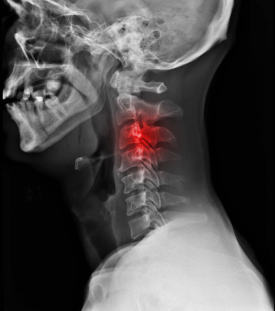 X-ray of paniful neck. stock photo