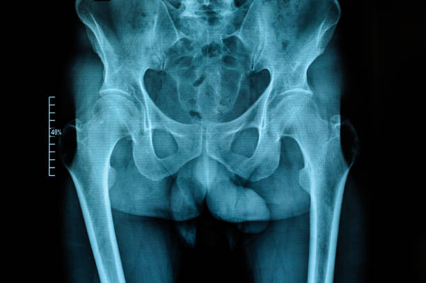 X-ray of the hip joints. Osteoarthritis. X-ray of the hip joints of an adult male with osteoarthritis. Selective focus. Blur. Noise, sharpness and grain are typical for X-rays. Horizontal orientation. pelvis photos stock pictures, royalty-free photos & images