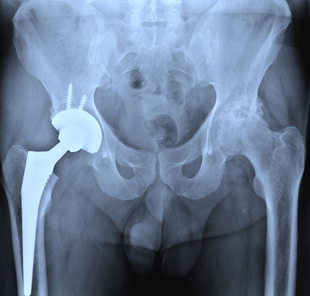 X-ray of the hip prostesis stock photo