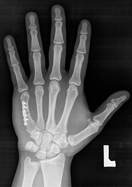 X-ray of the left hand. V metacarpal bone with implant. X-ray of the left hand. V metacarpal bone implanted surgically after bone fracture. x ray plates stock pictures, royalty-free photos & images