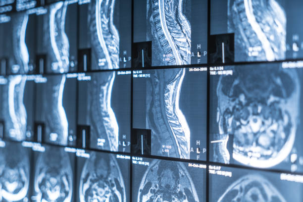 X-ray of the neck MRI. Vertebrae, osteochondrosis stock photo