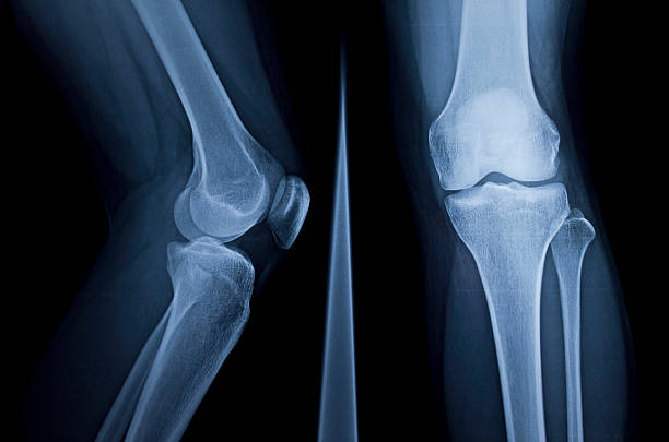 X-Ray X-Ray of human knee human knee stock pictures, royalty-free photos & images