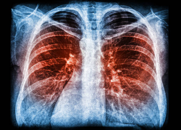 X-ray scan of pneumonia lung infection X-ray scan of pneumonia lung infection bubonic plague photos stock pictures, royalty-free photos & images
