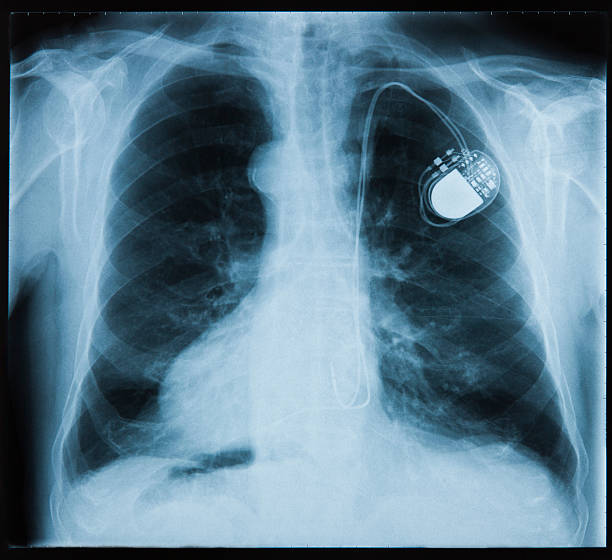 X-ray showing a pace maker in the chest stock photo