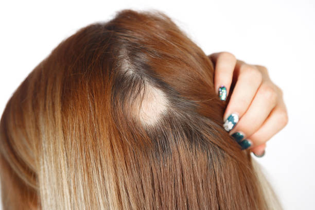 30 year old Caucasian woman with spot alopecia, bald spot on her head stock photo