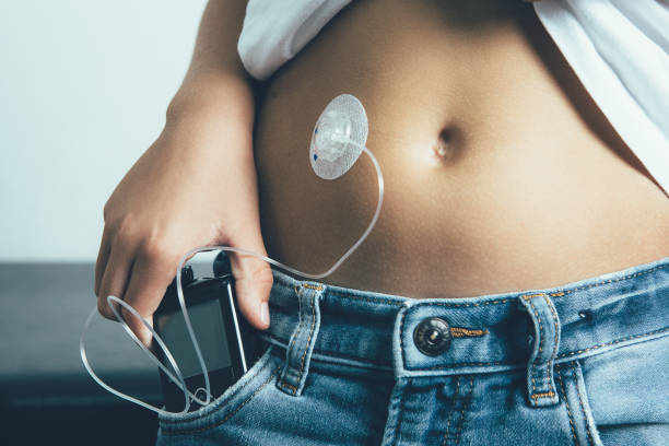 Young diabetic patient keeps an insulin pump in the pocket Close up view of the abdomen of a diabetic child with an insulin pump dressing connected in his abdomen and keeping the insulin pump in his pocket. Child diabetes concept. infused photos stock pictures, royalty-free photos & images