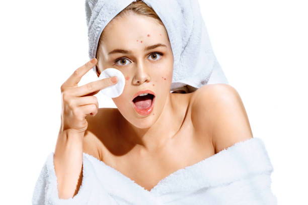 Young girl in shock of her acne with cotton pad in her hand Young girl in shock of her acne with cotton pad in her hand. Portrait of ugly girl with towel on her head. Skin problem hd makeup stock pictures, royalty-free photos & images