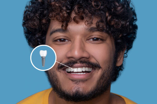 junger mann mit einem zahnigen lächeln, der sein zahnimplantat demonstriert - zahnimplantat stock-fotos und bilder