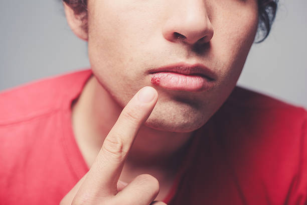 Young man with cold sore stock photo