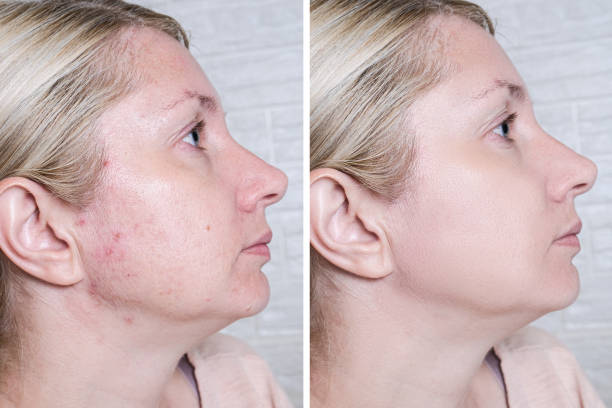 Young woman before and after anti acne treatment, skincare and dermatology concept Young woman before and after anti acne treatment, skincare and dermatology concept. imperfection photos stock pictures, royalty-free photos & images