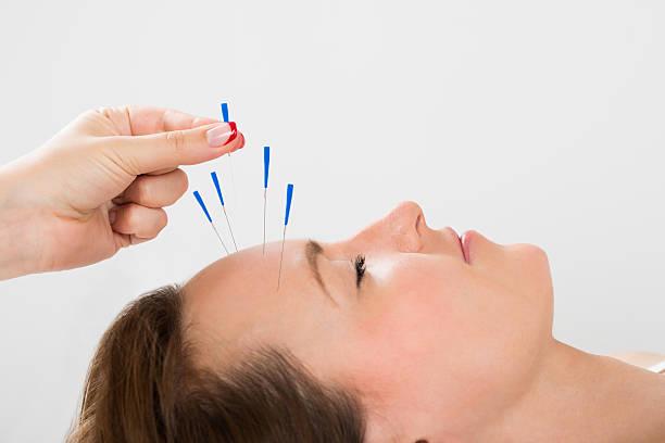 Young Woman Receiving Acupuncture Treatment Close-up Of Young Beautiful Woman Receiving Acupuncture Treatment acupuncture stock pictures, royalty-free photos & images