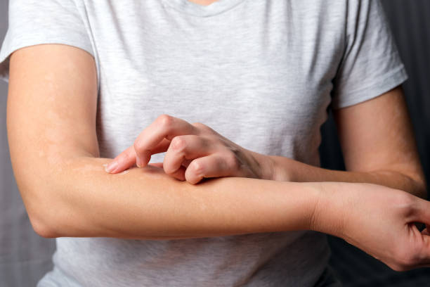 Mujer joven se frota las manos con crema anti-dermatitis por picazón. Dermatitis alérgica. Enfermedad de la piel vitiligo. Enfermedad de neurodermatitis, eccema o erupción alérgica. Cuidado de la salud y médico..
