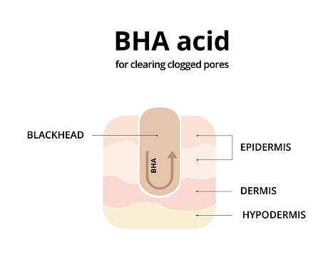 BHA acid for cleaning clogged pores