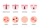 Acne formation and types, skin problems vector icons