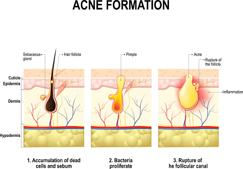 Acne Formation Human Skin Stock Illustration - Download Image Now - iStock