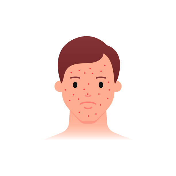 ilustrações de stock, clip art, desenhos animados e ícones de acne problem icon, male character. flat style. - varíola