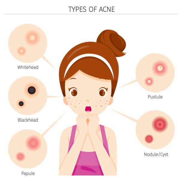 Image result for acne clipart