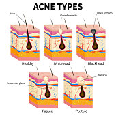 Acne types. Pimple skin diseases anatomy medical vector diagram. Illustration of follicle and pimple, medicine anatomy, papule and pustule